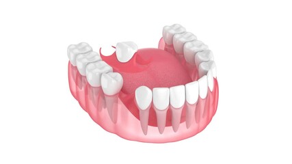 Jaw with removable partial denture isolated over white background