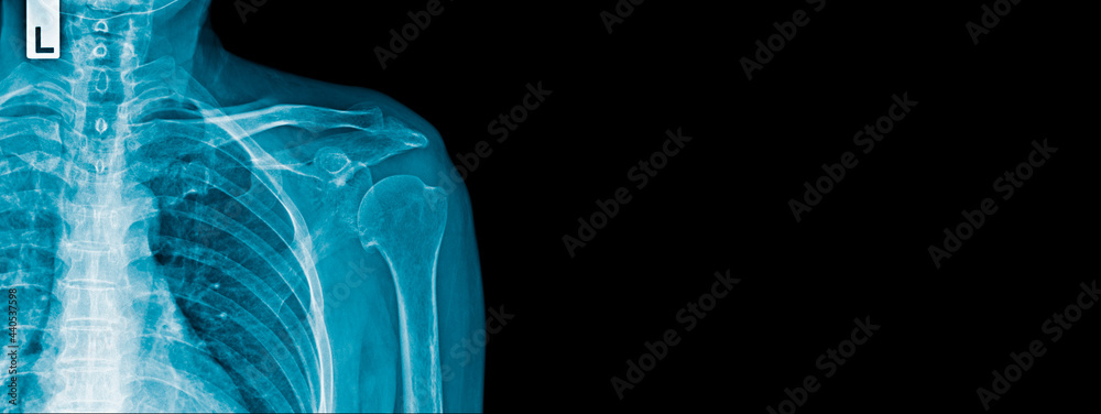 Sticker x-ray shoulder banner design in blue tone