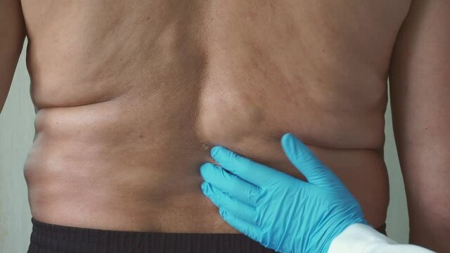 A doctor in blue rubber gloves and a white lab coat examines and palpates a man with lipomas - benign tumors on the body. multiple lipomas