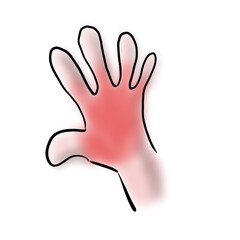 Inflammation on the human hand