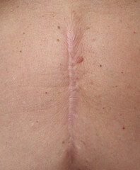 Scar on the abdomen after surgery 14 years later