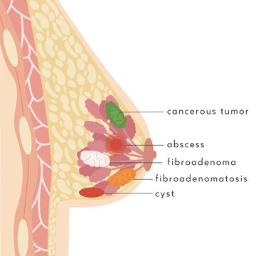 Medical Infographic Cross Section of Female Breast with various diseases. Information card with benign and cancerous lesion, tumor or cyst. Anatomy of Woman Breast with cancer. Mammary gland. Vector.