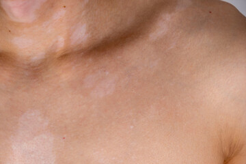 human skin with vitiligo close-up