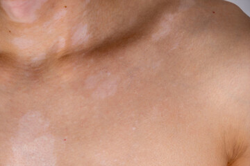 Fototapeta premium human skin with vitiligo close-up