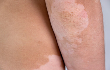 human skin with vitiligo close-up