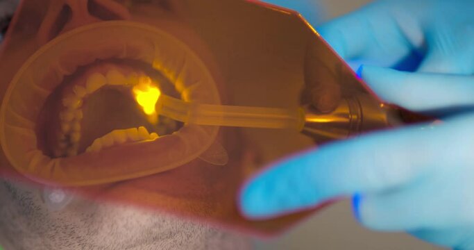 Close-up an Arabian male patient with optragate and ceramic braces on teeth is having teeth treatment by using curing light for solidification filling on a tooth.
