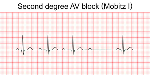 Electrocardiogram show second degree AV block (Mobitz I) or wenckebach pattern. ECG. EKG. Vital sign. Heart beat. Life line. Medical healthcare symbol. - obrazy, fototapety, plakaty