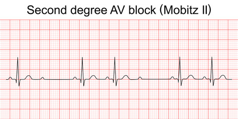 Electrocardiogram show second degree AV block (Mobitz II) pattern. ECG. EKG. Vital sign. Heart beat. Life line. Medical healthcare symbol.