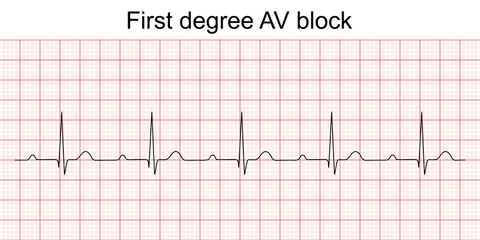 Electrocardiogram show first degree AV block pattern. ECG. EKG. Vital sign. Heart beat. Life line. Medical healthcare symbol. - obrazy, fototapety, plakaty