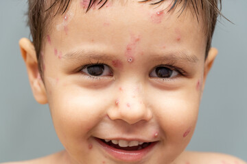 Cheerful kid face with ulcers, rash from chickenpox, varicella