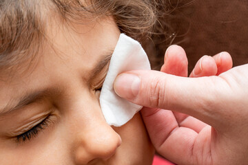 treatment of sick, red child eye with conjunctivitis, with a cotton swab
