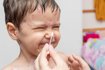 treatment of ulcers, rash from chickenpox, varicella on dissatisfied kid face