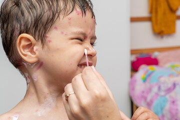 treatment of ulcers, rash from chickenpox, varicella on dissatisfied kid face