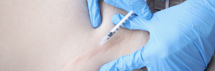Gloved doctor injects the keloid scar closeup