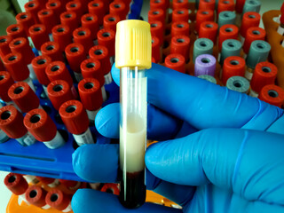 Scientist hold Lipemic blood sample, high Triglyceride contain serum sample. Lipemia in a blood specimen can cause significant interference with obtaining accurate test values