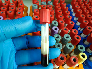 Scientist hold Lipemic blood sample, high Triglyceride contain serum sample. Lipemia in a blood...