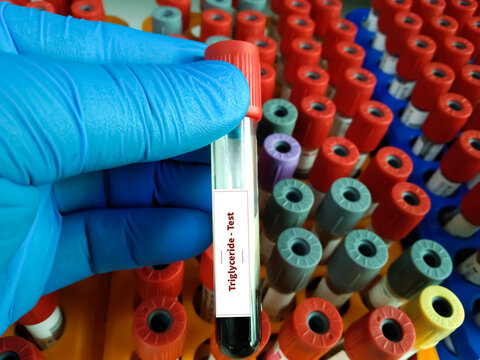 Lipemic Serum Blood Sample Tube Holding By Medical Technologist. To Estimate Triglyceride, Lipid Profile, Cholesterol And Cardiac Marker Of A Patient At Medical Laboratory.