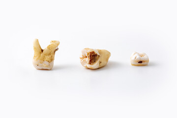 bad broken tooth adult man with severe tooth decay also known as dental caries or cavities due to bad oral hygiene, close up isolated on white background