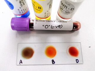 Blood group testing by slide agglutination method with sample and reagent bottles,show O Negative result. - obrazy, fototapety, plakaty