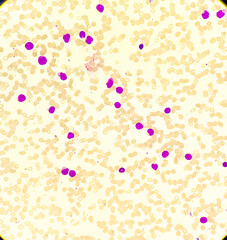 Photomicrograph of Acute Myeloid Leukemia (AML), Auer rods or Auer bodies present, One type of blood cancer,40x view