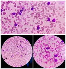 Photomicrograph of Acute Myeloid Leukemia (AML), Auer rods or Auer bodies present, One type of...