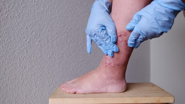 doctor, nurse, in blue gloves, heals with a medicine a wound on female leg with a medicine, medical concept, psychological aspect of self-harm