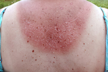 Burned skin on the back. Incorrect tanning of the body. Sun prevention concept.