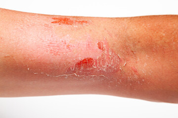 Part of a man's hand with sunburn and peeling of the skin in the bicep area on a white background.