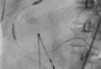 coronary artery angiography ,Coronary artery disease 