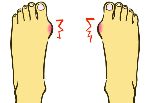 174 Best 外反母趾images Stock Photos Vectors Adobe Stock