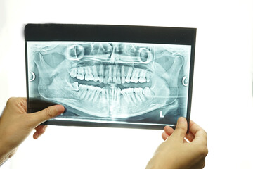 X Ray image of teeth and mouth