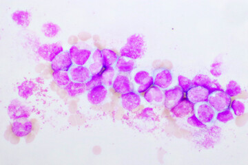 Chronic myeloid leukemia cells or CML, analyze by microscope, original magnification 1000x - obrazy, fototapety, plakaty