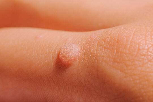 Common wart Verruca vulgaris a flat wart commonly found on the hand of children and adults. They are caused by a type of human papillomavirus HPV.