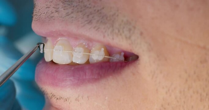 Close-up male mouth with ceramic braces on teeth and orthodontist hand in blue gloves using dental forceps while putting black ligature ties on braces. The patient is having orthodontic treatment.
