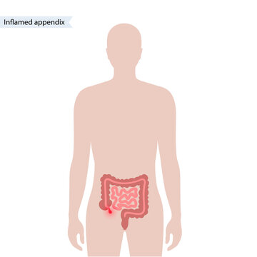 Appendix pain concept