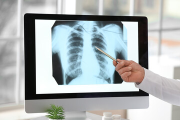 Pulmonologist pointing at x-ray image of lungs in clinic