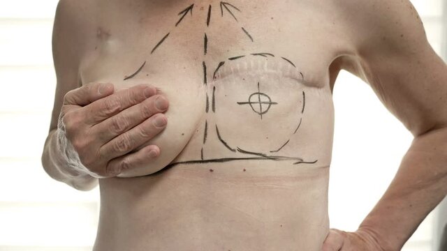 Preparing for breast reconstruction for a woman undergoing mastectomy. Breast plastic surgery after mastectomy.