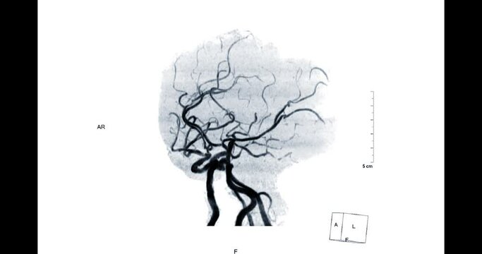 MRA Brain or Magnetic resonance angiography of the brain MIP TOF technique view showing cerebral artery on white background.