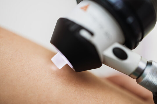 Close up shot of modern dermatology skin check up with digital deramatoscope. Dermoscopy microscope procedure and skin cancer prevention treatment.
