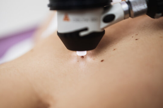 Close up shot of modern dermatology skin check up with digital deramatoscope. Dermoscopy microscope procedure and skin cancer prevention treatment.