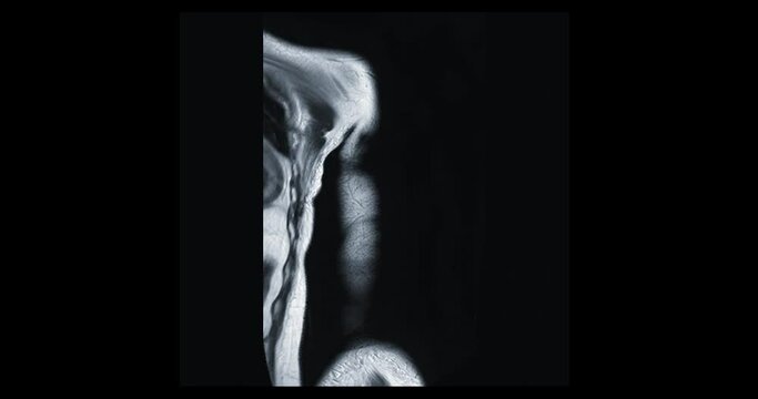 MRI Arm or humerus bone  , Magnetic resonance imaging of  Arm or humerus  Coronal T1W  for diagnosis mass or arthritis and including tears and impingement.