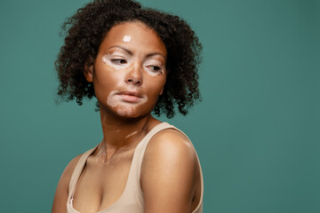 Young woman with vitiligo posing while looking aside