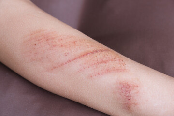Wounds, scratches and abrasions on skin of child leg. Children injury.