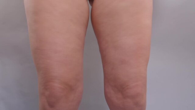 Movement with fat on a woman's legs. She shakes hips, shows her leg size with hand. Consequences of a sedentary lifestyle.