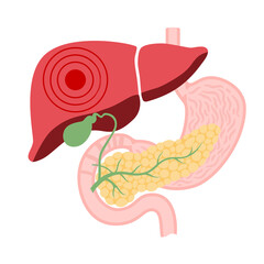 Liver disease concept