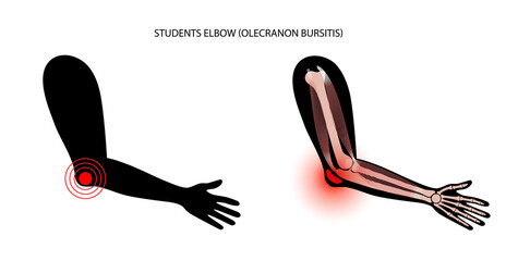 Student elbow bursitis
