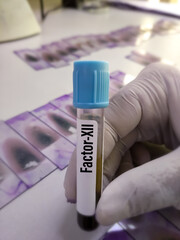 Blood sample for Factor XII or Hageman factor test, diagnosis of coagulation disorder