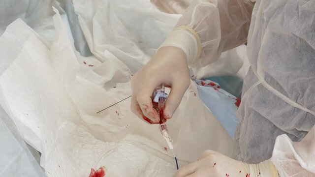 Modern technology in the diagnosis of heart disease. Angiograph. Interventional cardiology. Stenting of the affected coronary artery on an angiograph. 