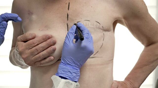 Preparing for breast reconstruction for a woman undergoing mastectomy. Breast plastic surgery after mastectomy.