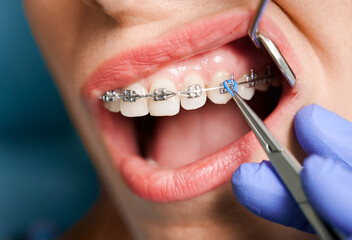 Close up of woman with brackets receiving dental braces treatment in clinic. Orthodontist using dental mirror and forceps while putting orthodontic braces on patient teeth. Concept of dentistry. - obrazy, fototapety, plakaty